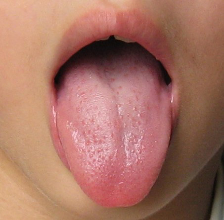 正常舌头