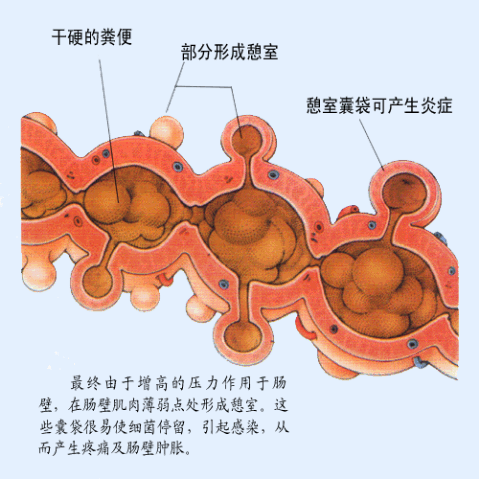 宿便的形成